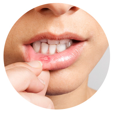ISDIN | Bexident AFTAS Spray | Aftas difícil acceso | 15 ml - Imagen 4